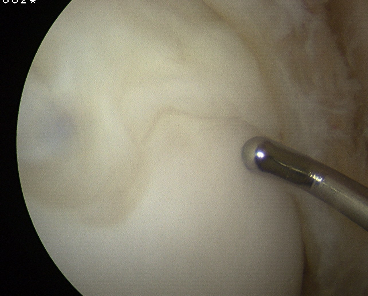 Knee OCD Case 1